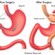 Gastric Bypass Surgery