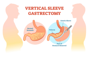 sleeve gastrectomy surgery
