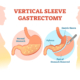 sleeve gastrectomy surgery