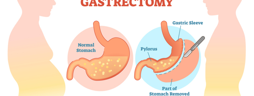sleeve gastrectomy surgery