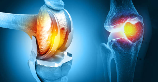 Myths About Knee Replacement Surgery