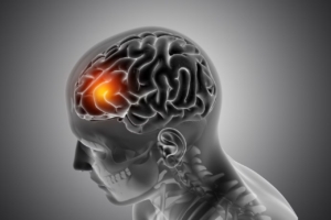 What is the Most Common Cause of Acute Stroke?