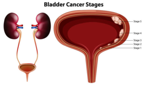 Bladder Cancer
