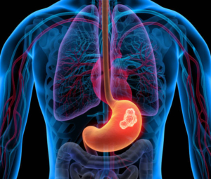 Gastric Cancer: Causes, Symptoms, Diagnosis & Treatment