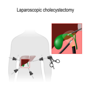 Laparoscopic Cholecystectomy