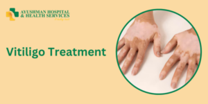 Vitiligo Treatment