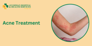 Urticaria Treatment in Dwarka Delhi